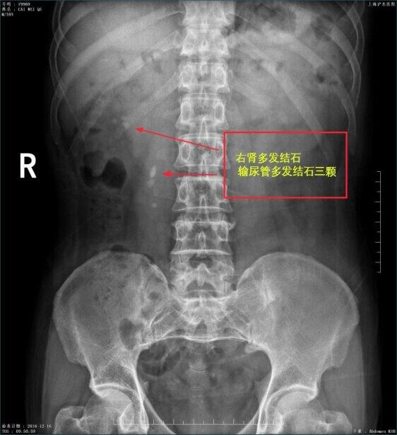 体外震波碎石费用详解，治疗选择与了解