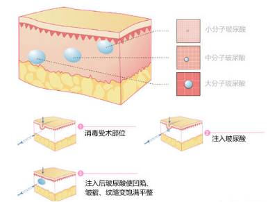 揭秘玻尿酸价格真相，全方位探讨与解读