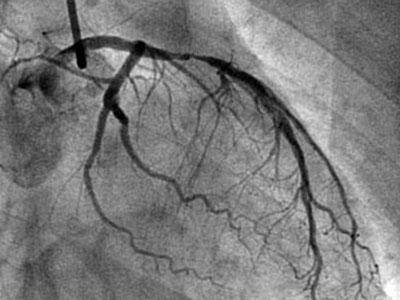 冠心病造影突发房颤，冠心病造影后期恢复 